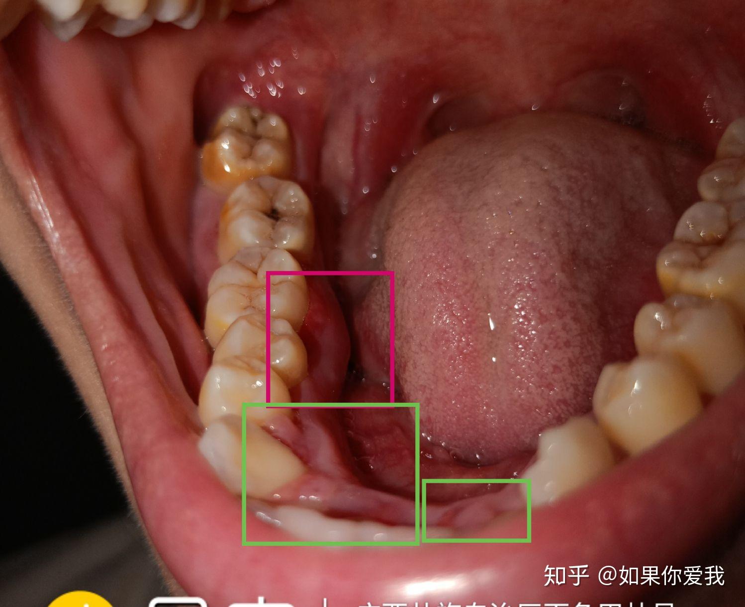 中弄破的牙龈形成的粘连和肿胀破损以上情况一直持续了差不多一个月