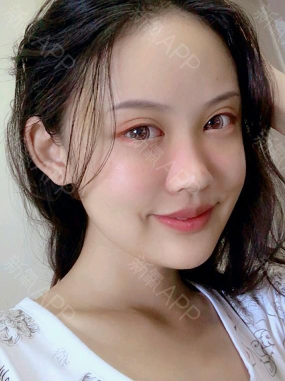 整容案例自体脂肪面部填充漂亮的脸蛋填出来