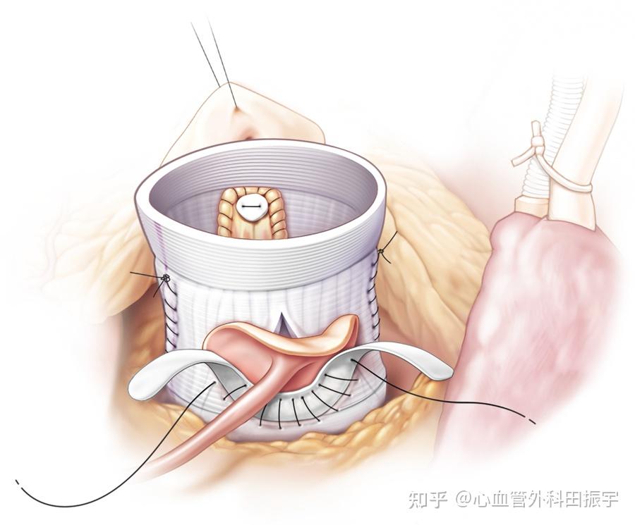 david手术(保留瓣膜的主动脉根部置换术) 