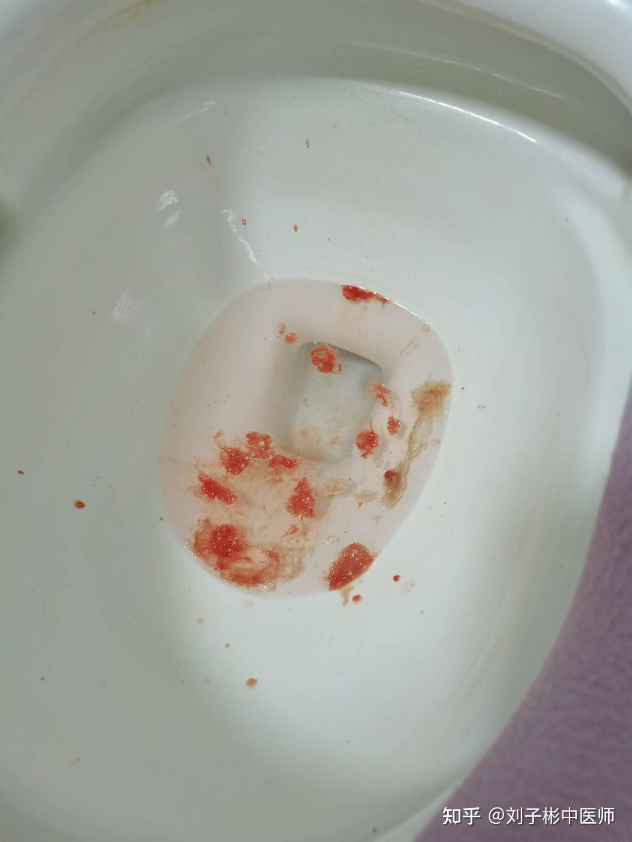 痰里带血一定是肺癌吗为什么在线