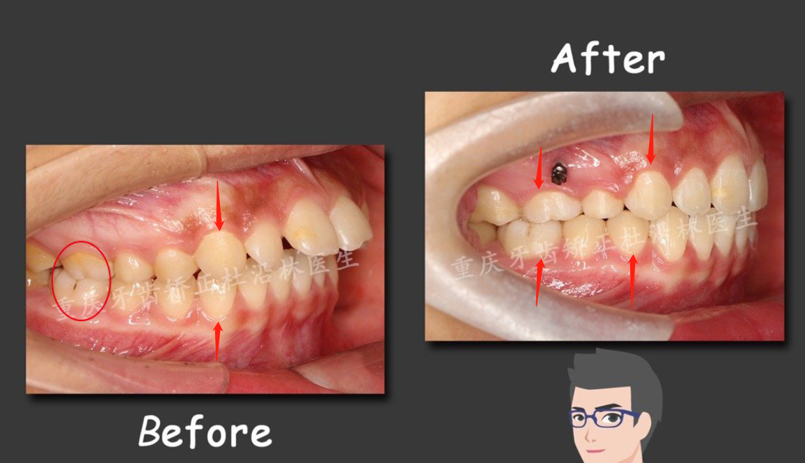 矫正前自查你的牙齿咬合关系正常吗安氏分类法