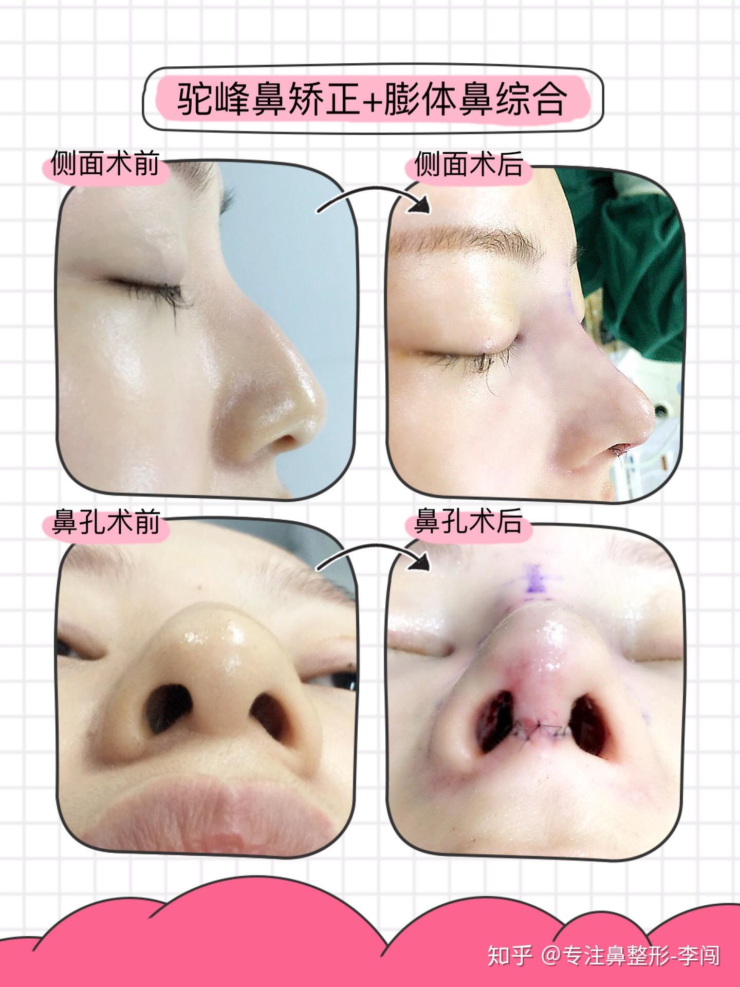 第六次驼峰鼻歪鼻修复矫正 - 知乎