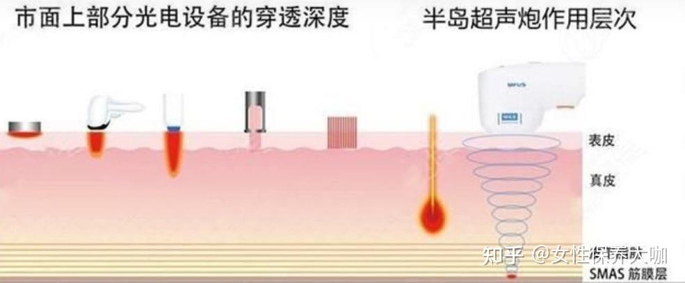 超声炮做了几天才恢复？做一次、超声炮能维持多久和年龄有关吗？ 知乎