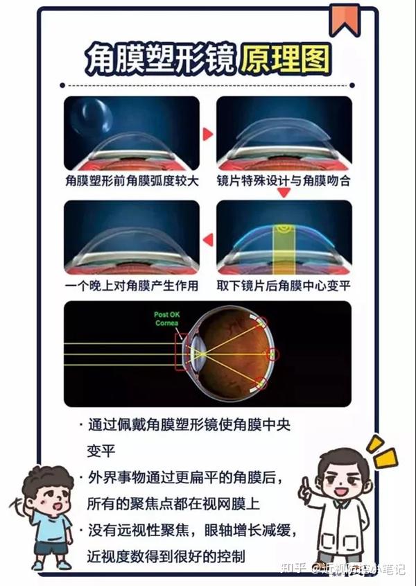 什么是ok镜，OK镜的适用人群 - 知乎