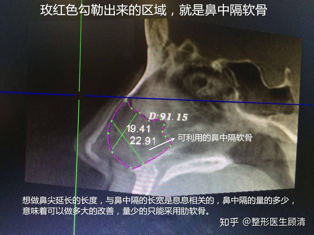 三维ct准确测量鼻中隔的大小和形态