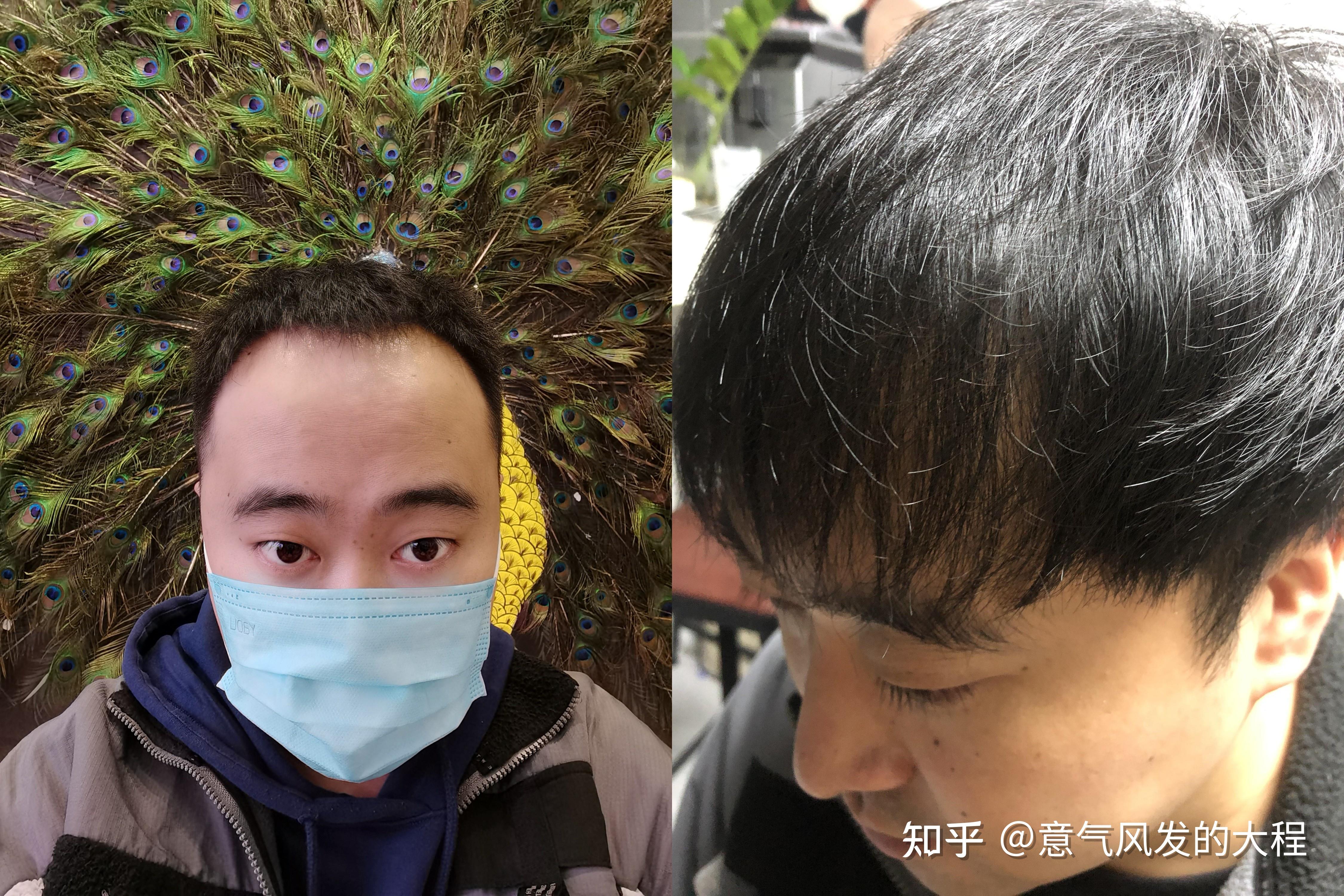 植发多久能吃牛羊肉(植发多久能吃牛羊肉和羊肉)