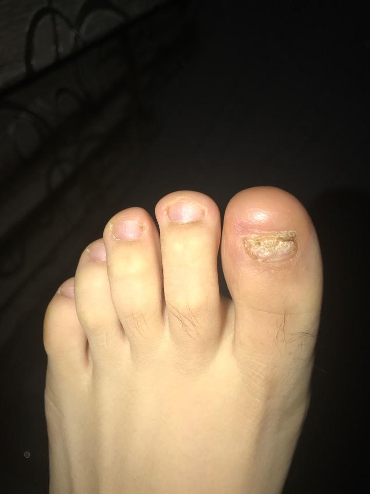 甲沟炎拔甲是怎样的体验? - 知乎