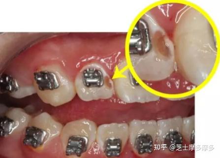正畸后牙齿脱矿怎么办?还有救吗? - 知乎