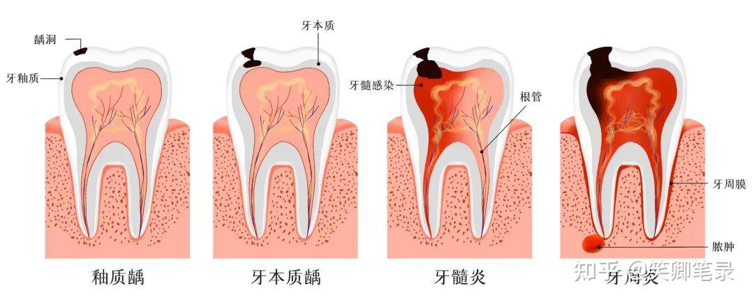 【徐浦口腔】为何好好刷牙却还是蛀了? - 知乎