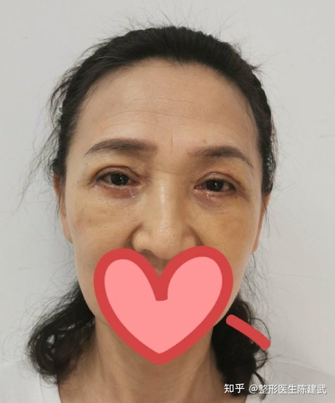 外切眼袋和双眼皮一起做,真香!