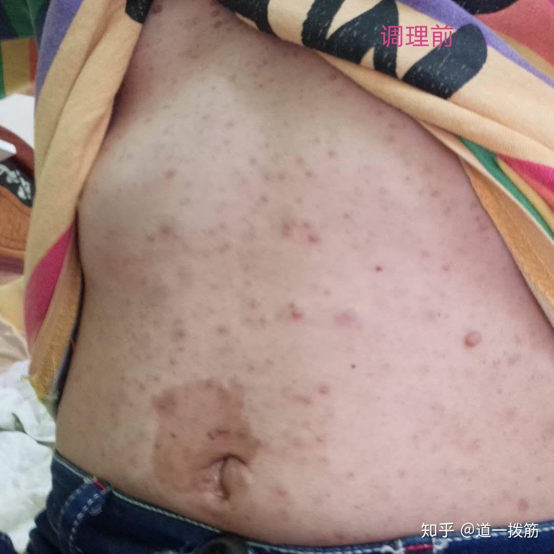 神经纤维瘤调理15天邵女士