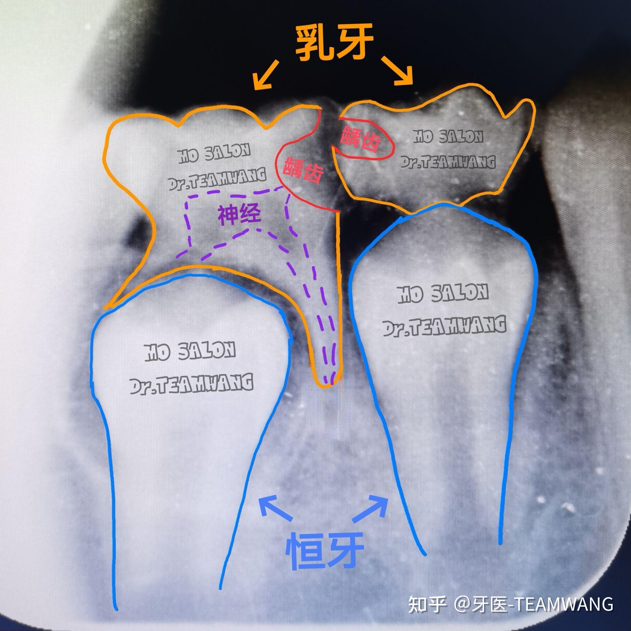 牙齿拍片解析图图片