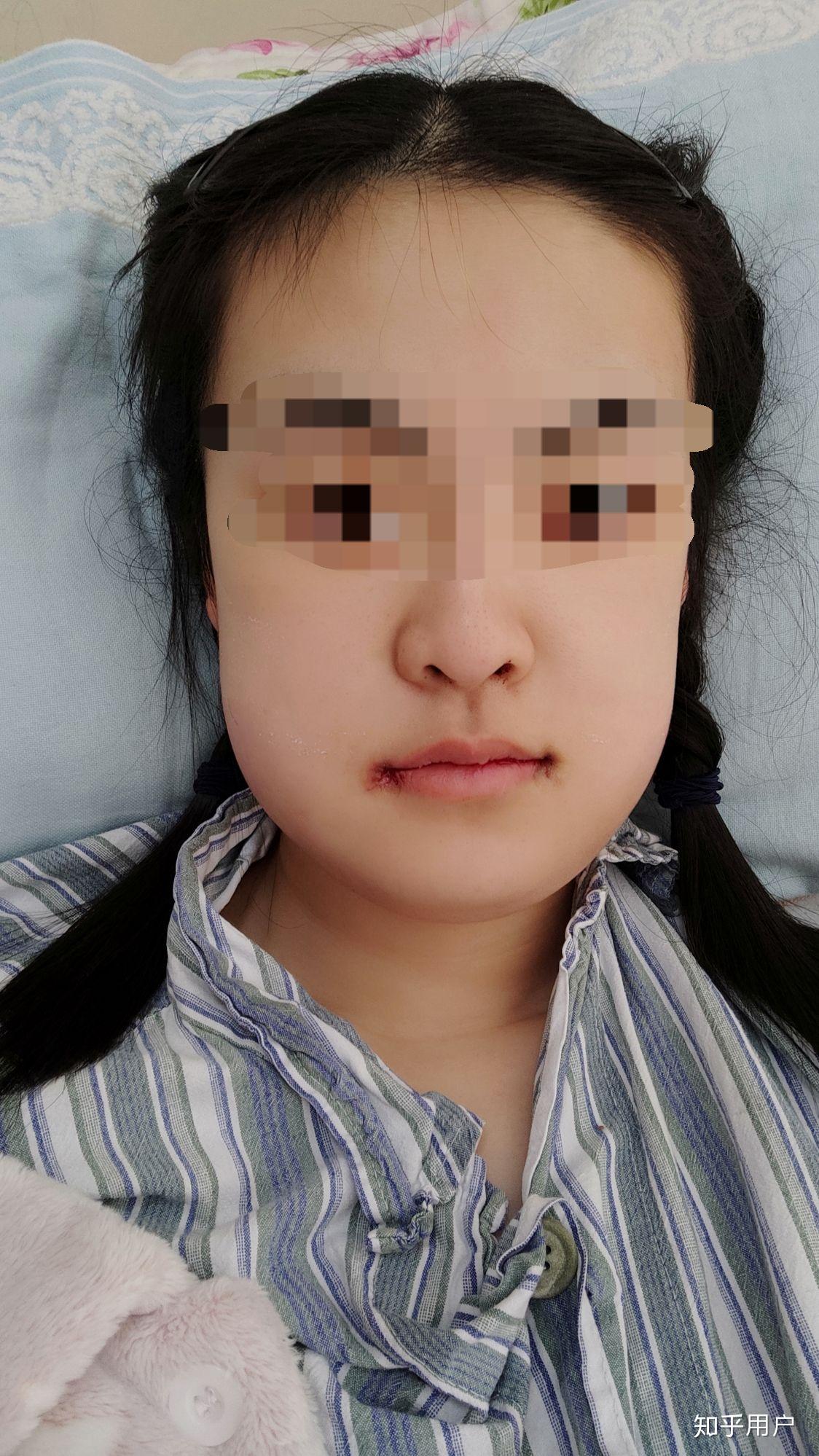 做正颌手术是怎样的体验? - 知乎