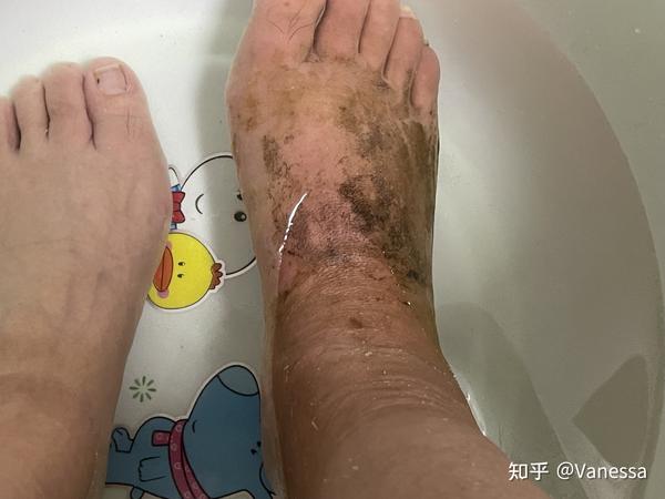 跖骨234骨折康复训练 跖骨骨折愈合过程图解 脚234跖骨是负重骨吗