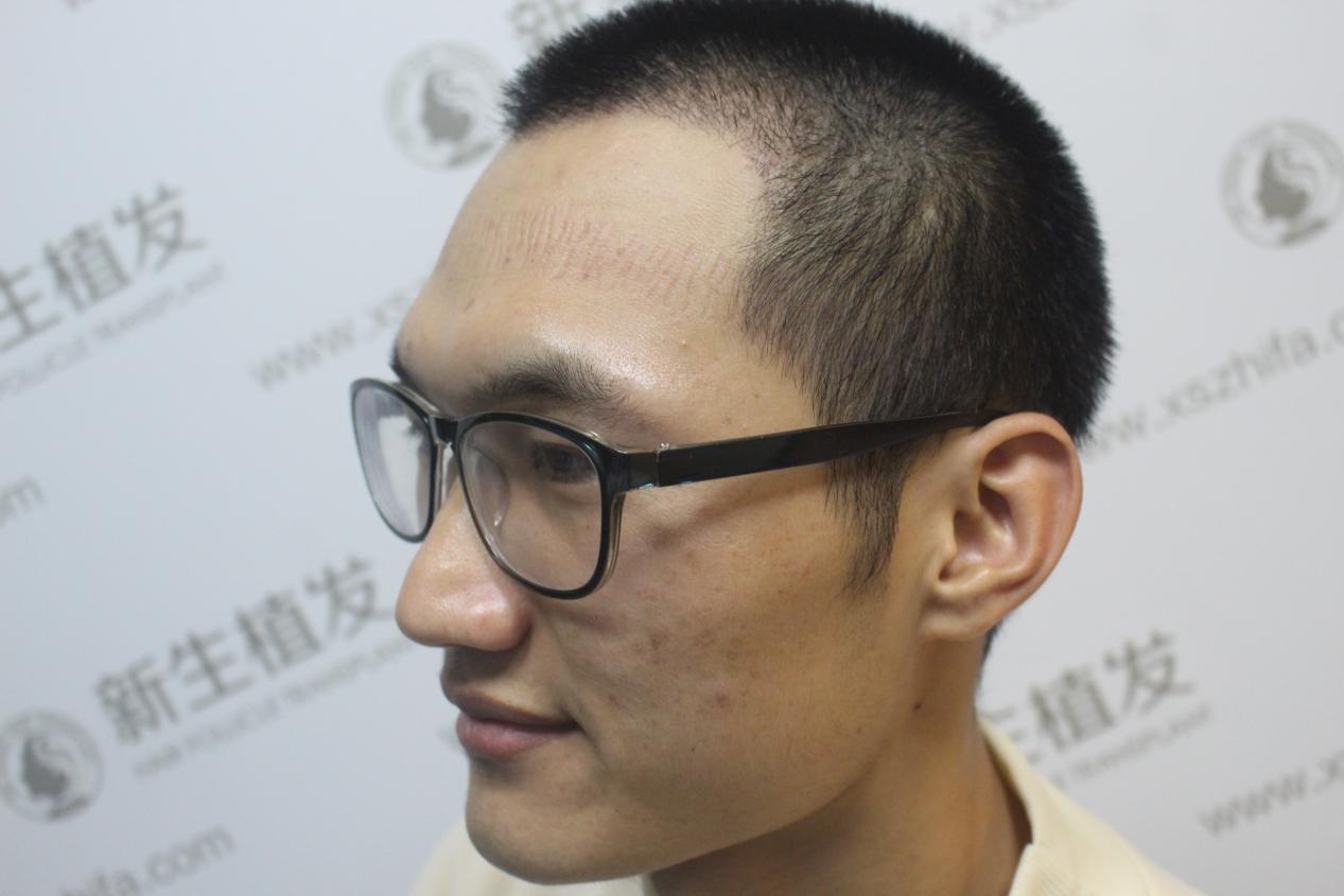 脱发对当代年轻人的影响20岁脱发就是小人