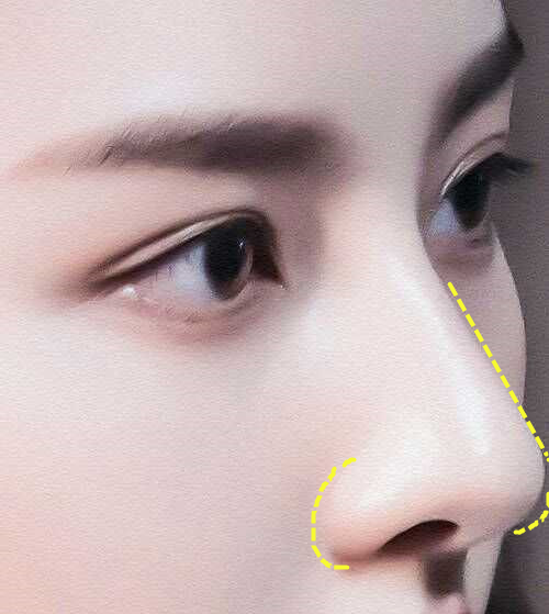 其实鼻翼和鼻头对于鼻子的美观度影响是相当大的,山根鼻梁高固然显得