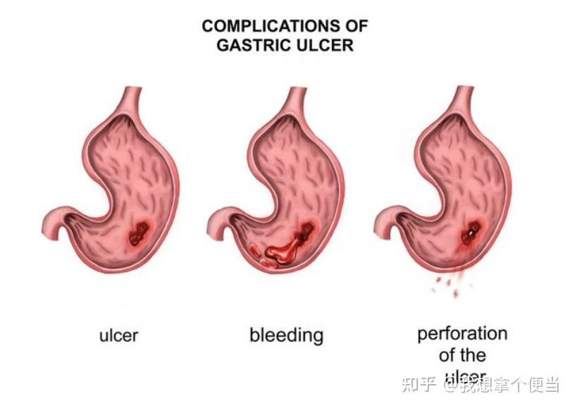 胃不舒服不要忍胃反酸忍出大毛病的年轻人不在少数