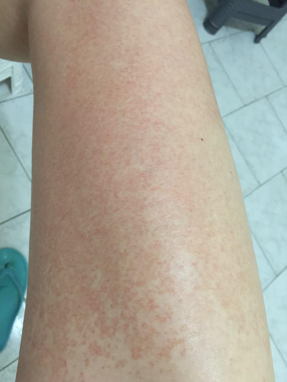 抗生素过敏皮肤起红点图片