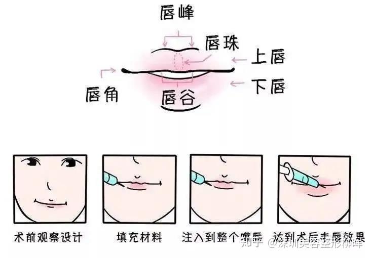 21岁分享玻尿酸丰唇体验:这就是我梦寐以求的丰唇! - 知乎