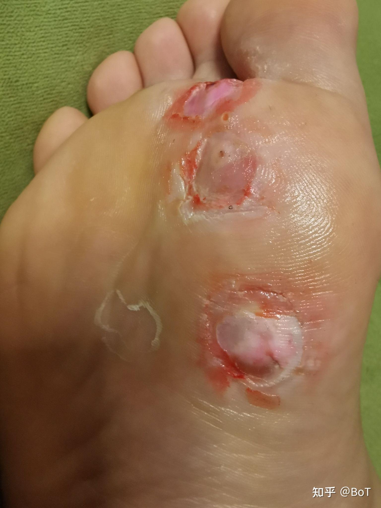 脚底拓疣的消除过程 - 知乎