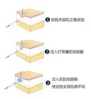 你之所以显老，大概就是鼻子旁的这条沟了~ - 知乎
