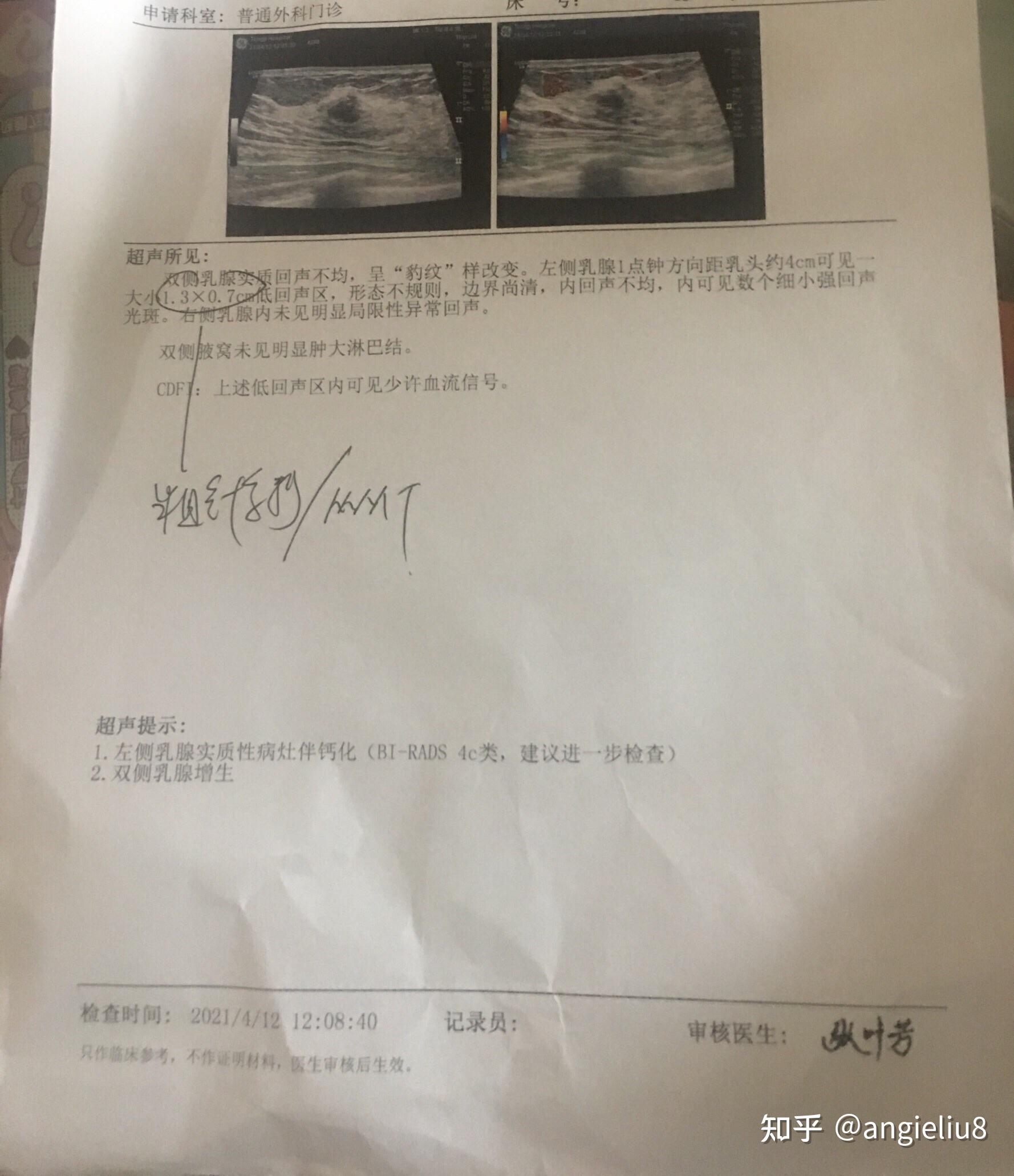 乳腺彩超4b翻盘！上海第一妇婴保健院乳腺手术 纤维瘤 乳腺肿瘤 妇科全面大检查后的发现！内附超详细 - 知乎