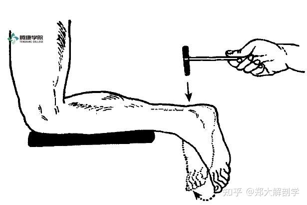 腱反射的反射过程图片