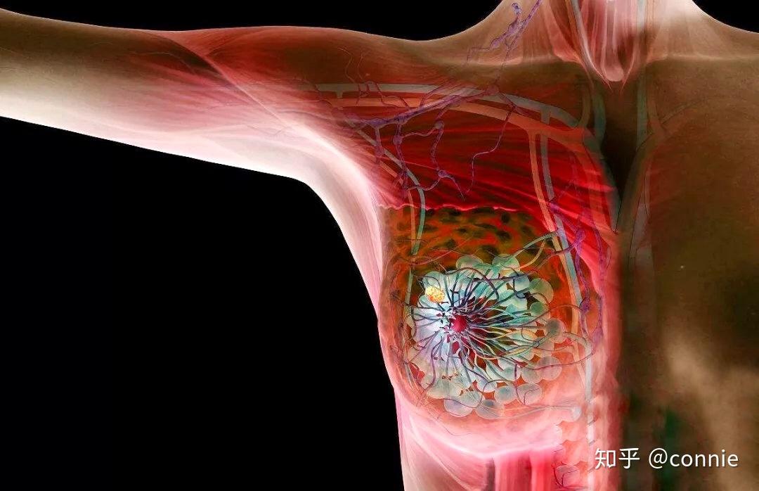 乳腺增生怎么办乳腺增生会发展成为乳腺癌吗乳腺增生和乳腺癌