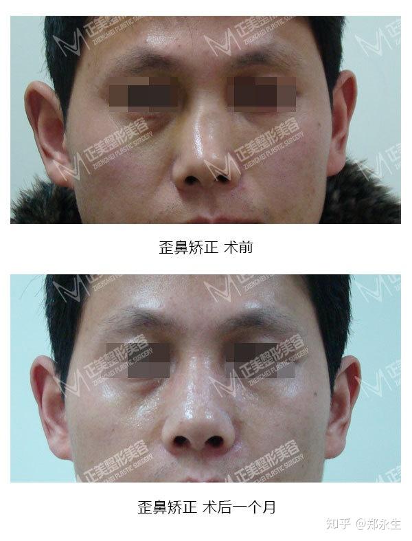 经典的歪鼻畸形矫正术方法主要包括三大步骤