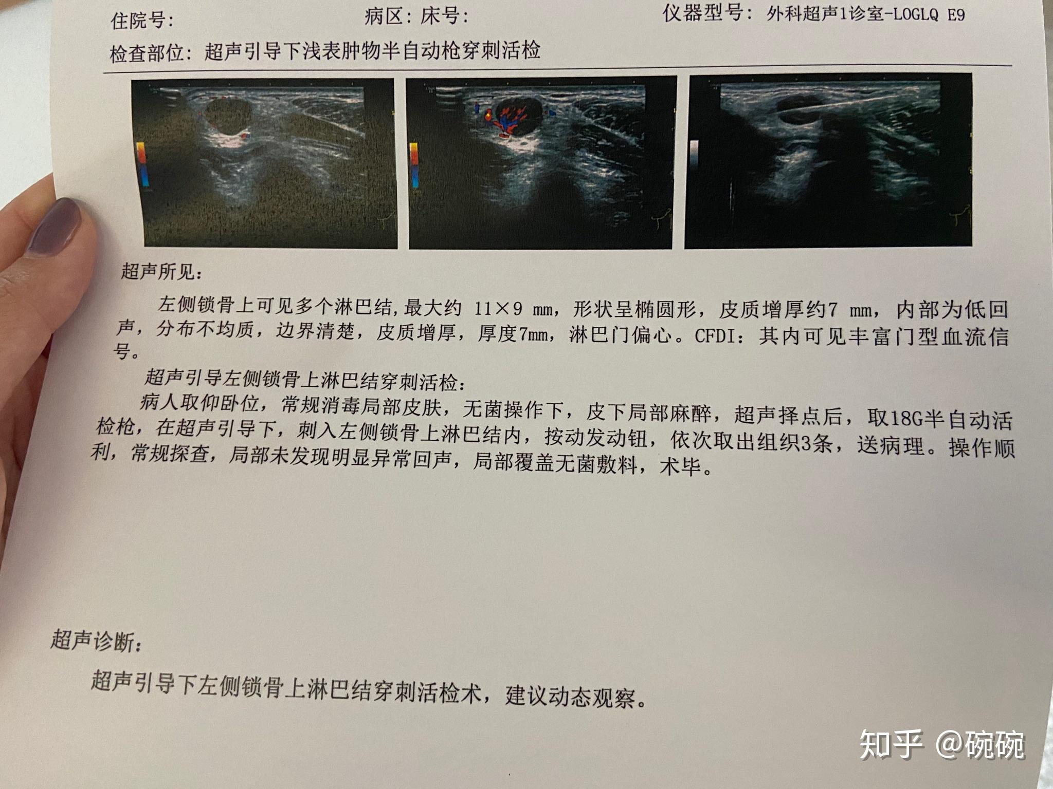 記錄淋巴腫大甲狀腺結節 - 知乎