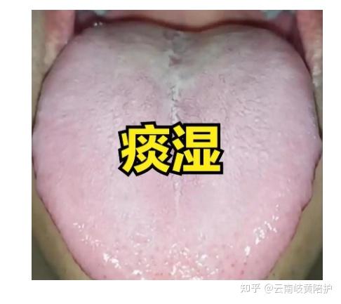 痰生百病,治痰的9种大法! - 知乎