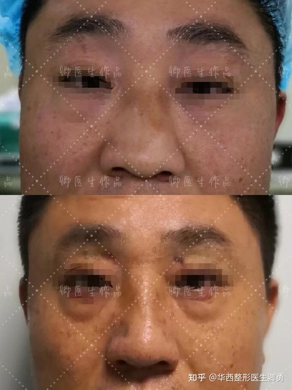 鼻软骨歪了怎么办 鼻软骨歪了能捏正吗 鼻中隔偏曲