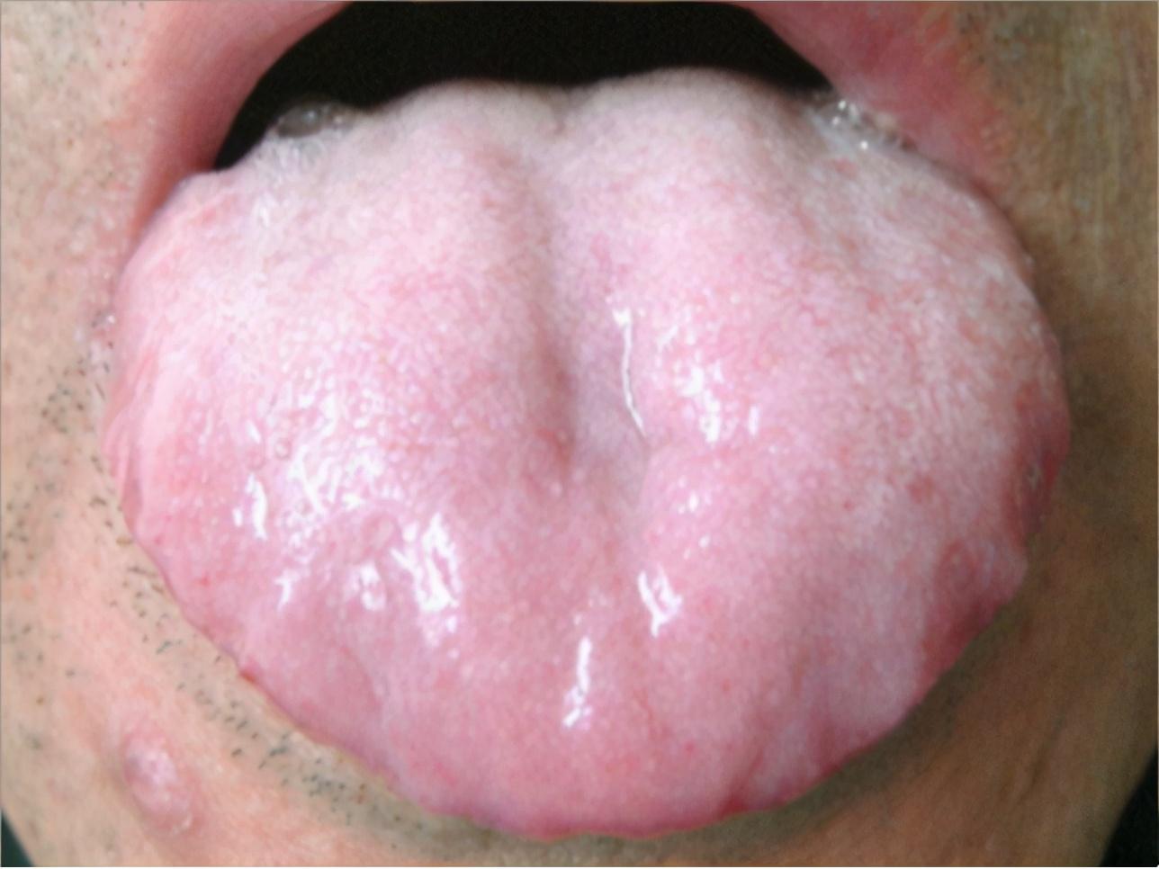 如邪热炽盛,大汗,吐泻后,或过服温燥药物等,导致津液不足,舌苔失于濡