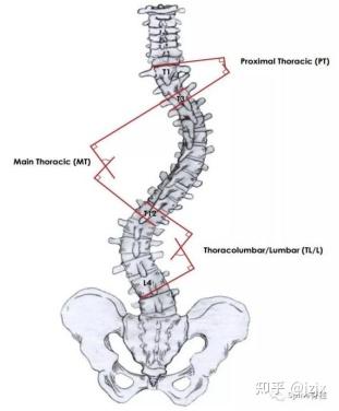 脊柱畸形角度测量 知乎