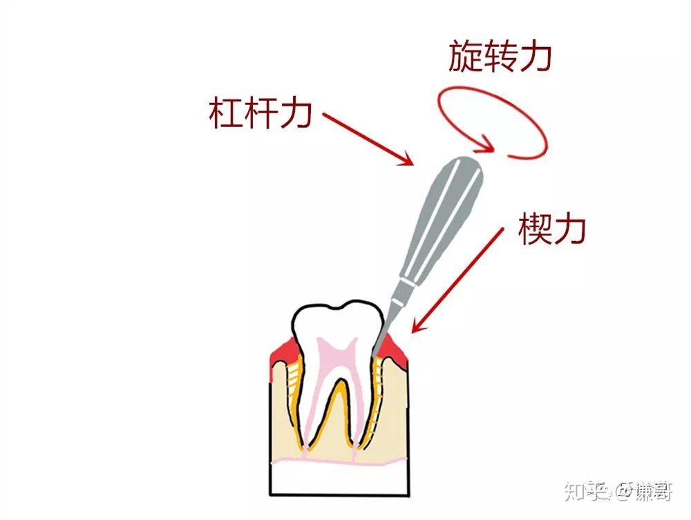 牙挺使用方法图片