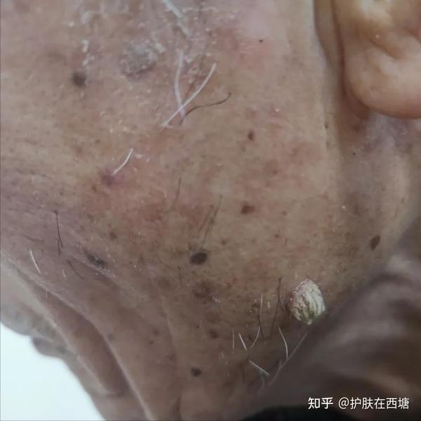 得和寻常疣或刺激性脂溢性角化病很相像，是否本来就同宗同源也很难说。医学上还有许多争议和未知，需要我们敬畏和探索。记得世纪之交在华山医