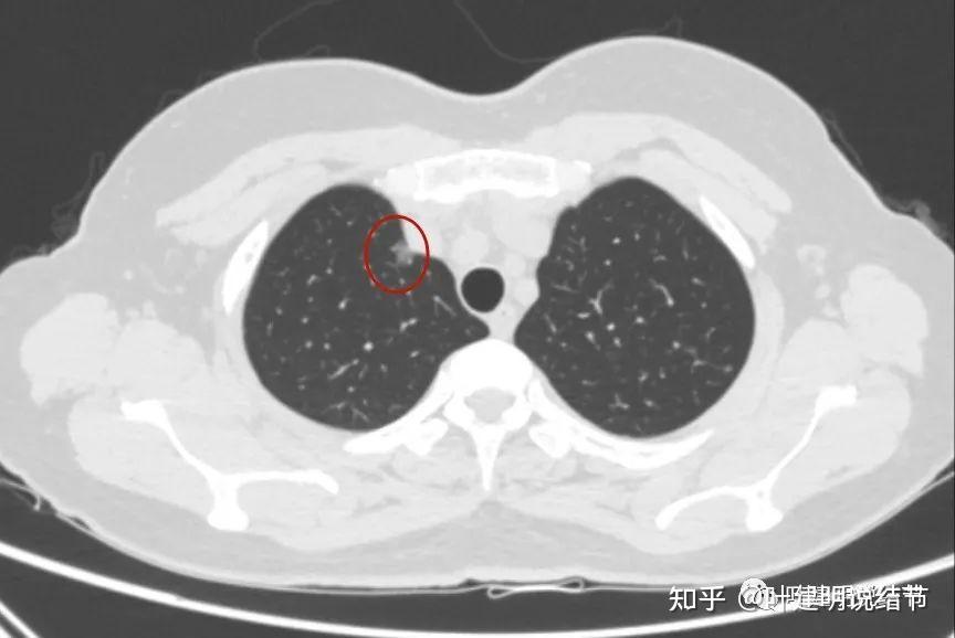 問診分析20231123多發肺磨玻璃結節的臨床決策要有別於孤立性結節操之