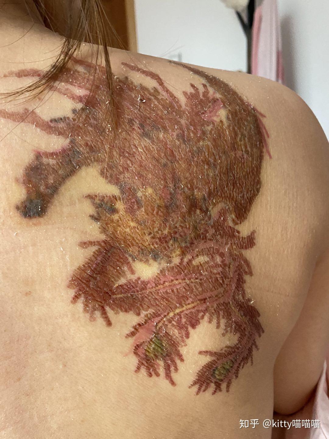 picoway超皮秒洗纹身/更新～应该是我最后一次登录知乎了 - 知乎