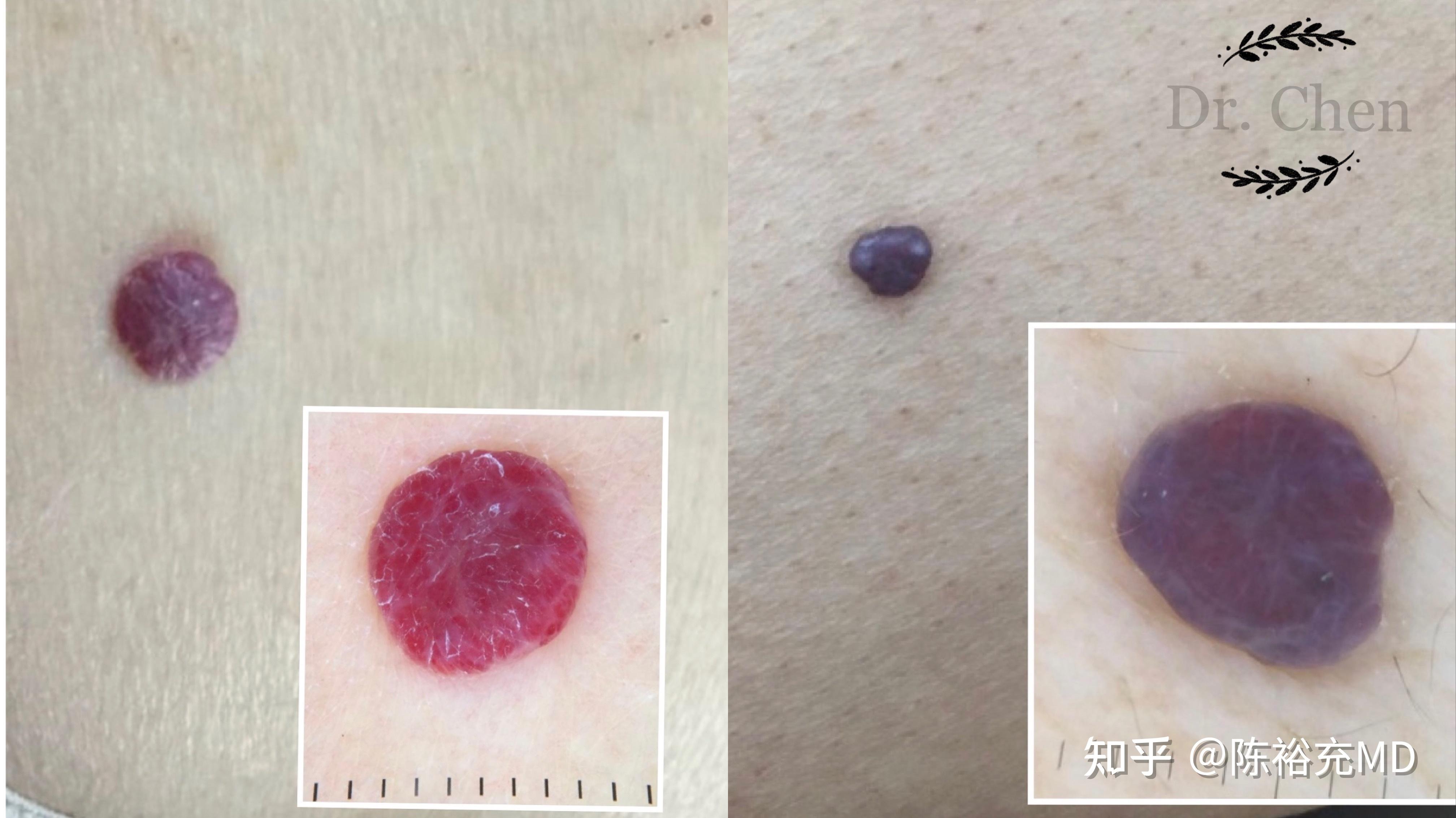 身上的小红点(樱桃样血管瘤)是怎么回事? - 知乎