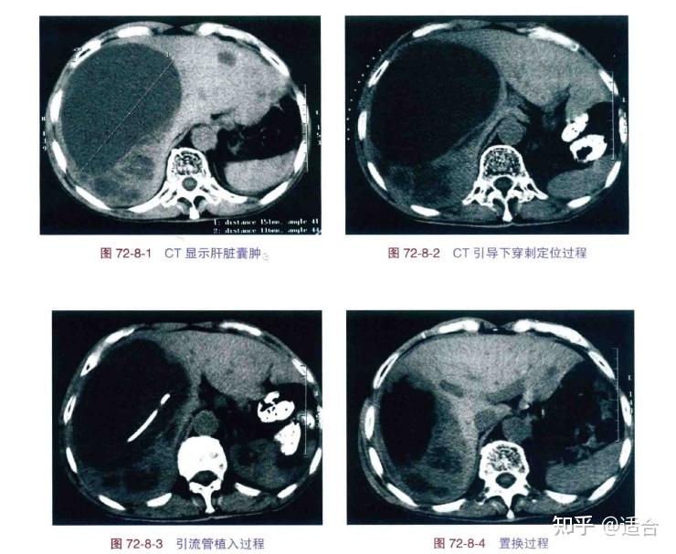 肝右叶囊肿图片