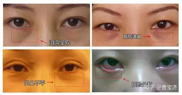 用什么可以去眼袋皱纹 v2-04213c2e01e44c39999989f3f40a5e4e_r.jpg