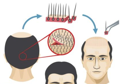 哪種程度脫髮適合植髮植髮後種上去的頭髮還會掉嗎
