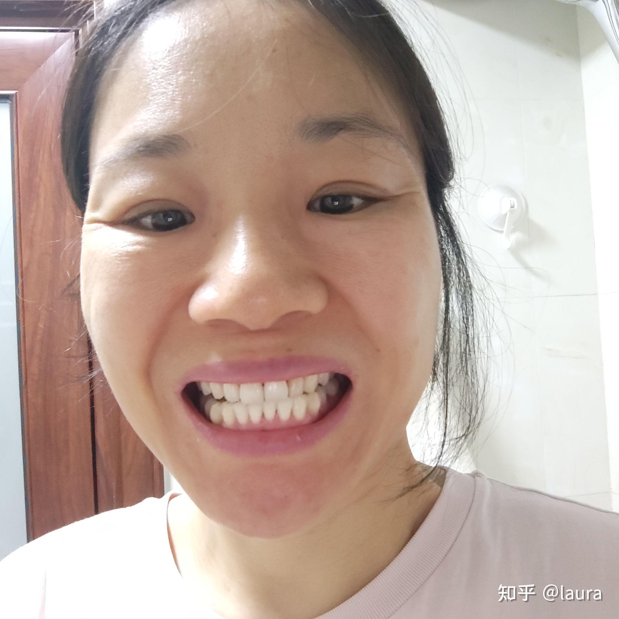 干燥综合症患者的牙保护的还行吧