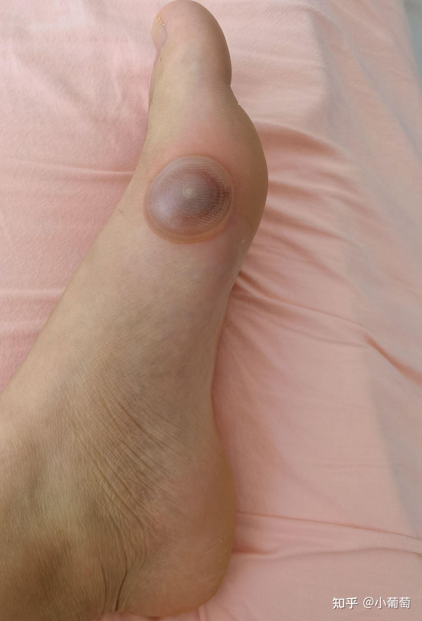 冰冻疣跖疣 - 知乎