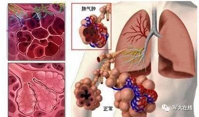 肺气肿有哪些症状图片