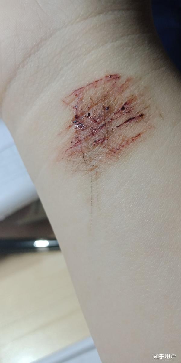 为什么抑郁症患者总选择割腕的方式自残?