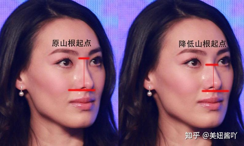 那么长中庭到底怎样做鼻子呢?