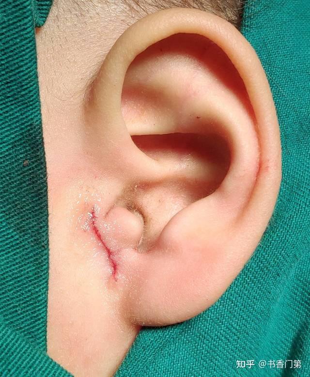 孩子附耳切除手术最佳年龄是几岁