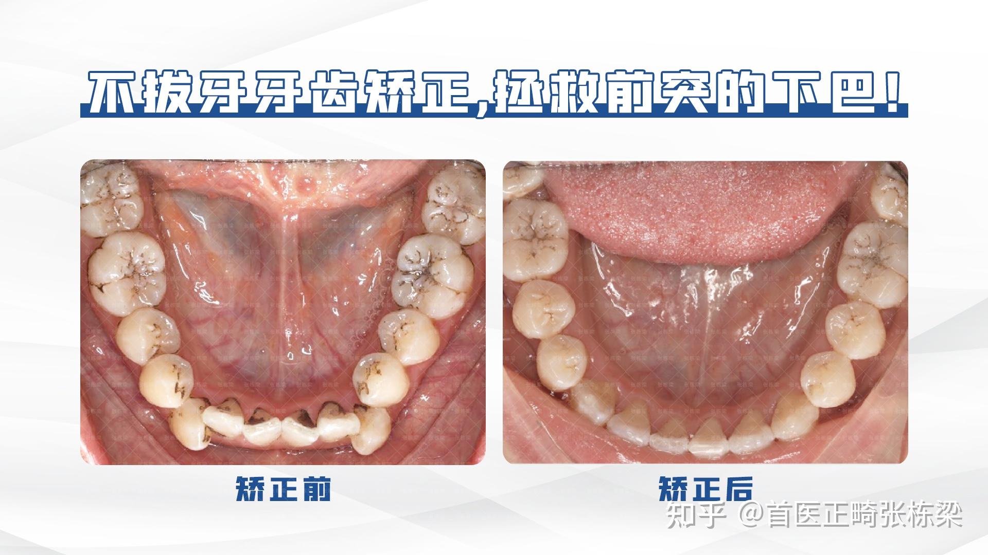 對齊中線,協調上下牙弓寬度;3,糾正矢狀向問題遠中直立尖牙及磨牙