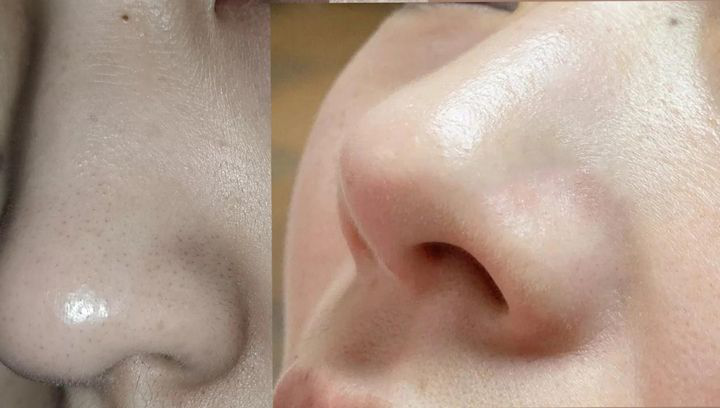 女生去黑头缩毛孔攻略女孩子安全去黑头方法步骤看这一篇就会了毛孔不